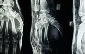 Já imaginou colar um osso quebrado em 3 minutos?