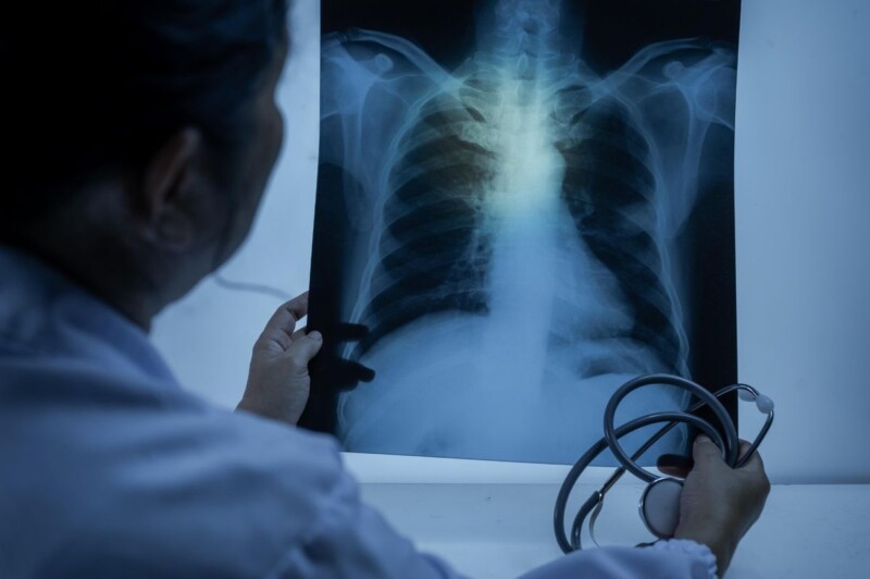 Pneumonia silenciosa avança de forma discreta e exige atenção no outono e inverno Pneumonia silenciosa avança de forma discreta e exige atenção no outono e inverno